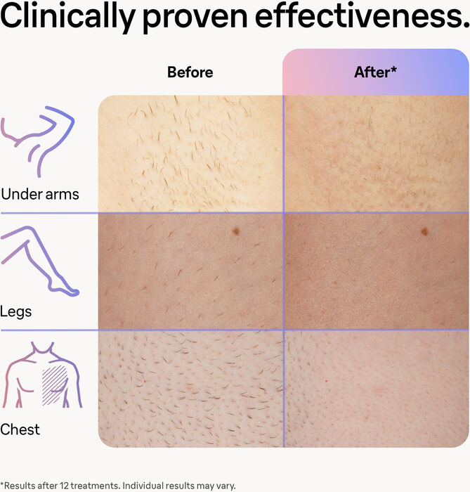 Braun Smart IPL Skin-i-Expert Pro 7 háreyðingartæki